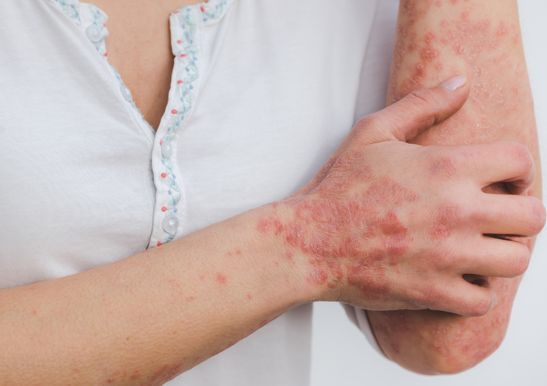 Ayurvedic Psoriasis Treatment in Chitlapakkam